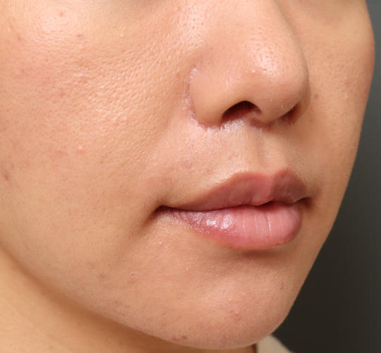 30代女性のM字リップ形成 After 症例写真