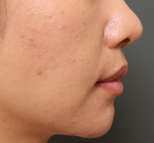 30代女性のM字リップ形成 After 症例写真