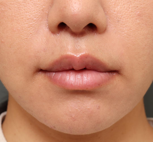 30代女性のM字リップ形成 After 症例写真
