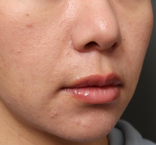 30代女性のM字リップ形成 Before 症例写真
