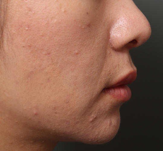 30代女性のM字リップ形成 Before 症例写真