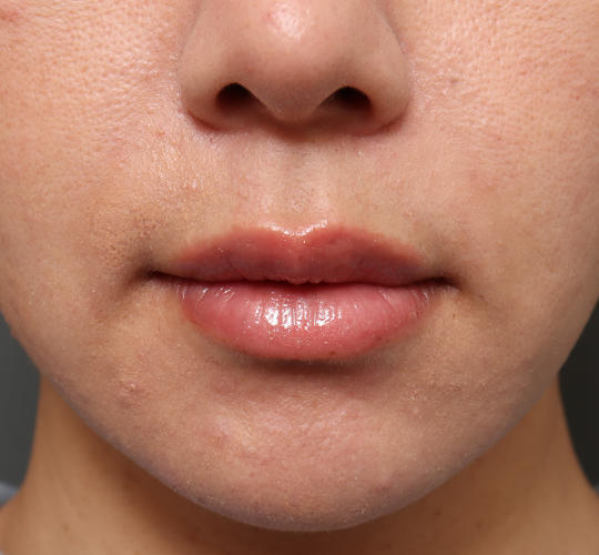 30代女性のM字リップ形成 Before 症例写真