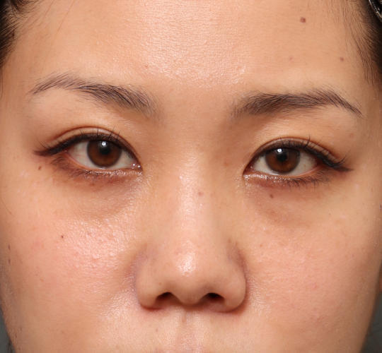 30代女性の3Dリポアイリフト Before 症例写真