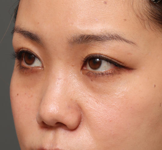 30代女性の3Dリポアイリフト  Before 症例写真