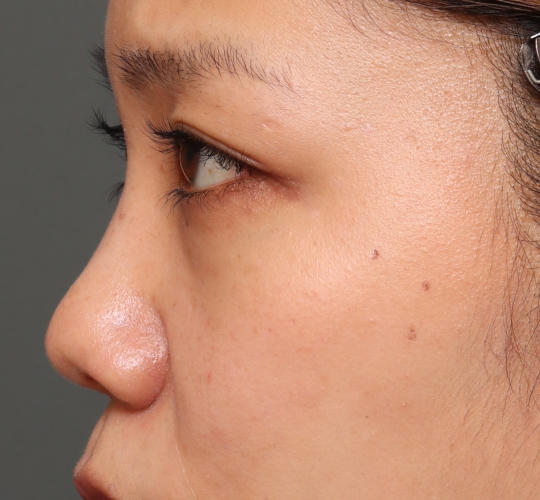 30代女性の3Dリポアイリフト  Before 症例写真