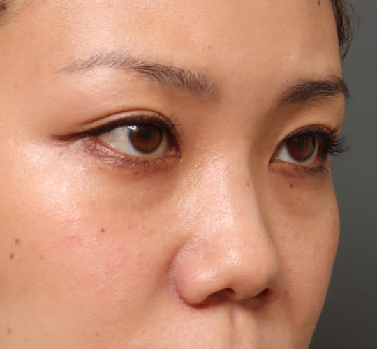 30代女性の3Dリポアイリフト  Before 症例写真