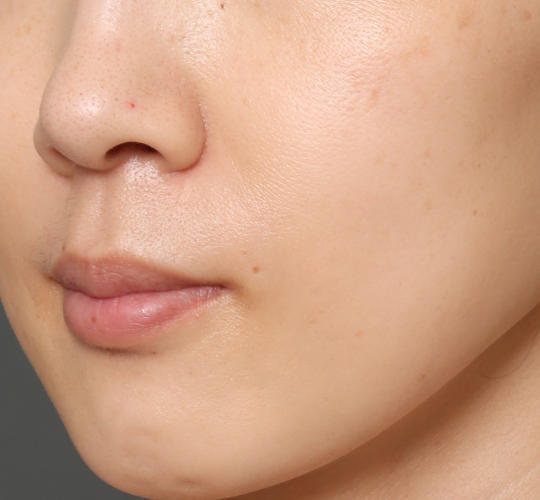 30代女性のヒアルロン酸注射（ほうれい線） After 症例写真