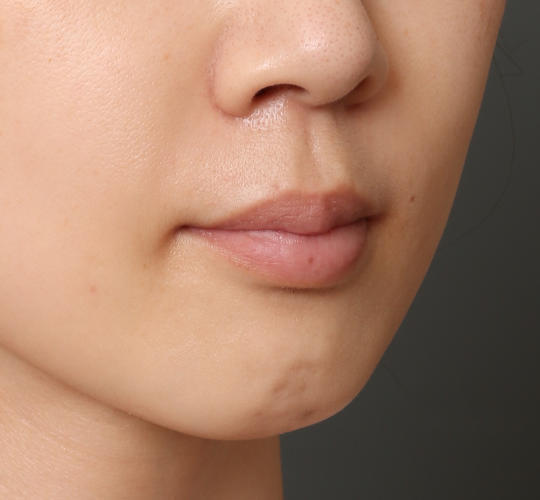 30代女性のヒアルロン酸注射（ほうれい線） After 症例写真