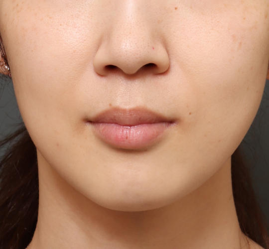 30代女性のシワ・たるみ Before 症例写真