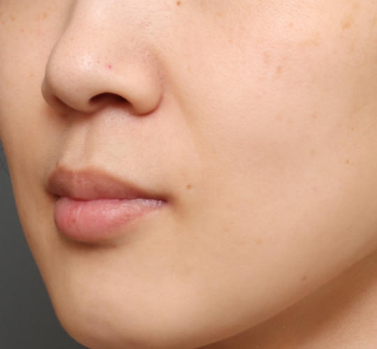 30代女性のヒアルロン酸注射（ほうれい線） Before 症例写真