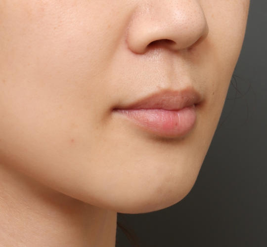 30代女性のヒアルロン酸注射（ほうれい線） Before 症例写真