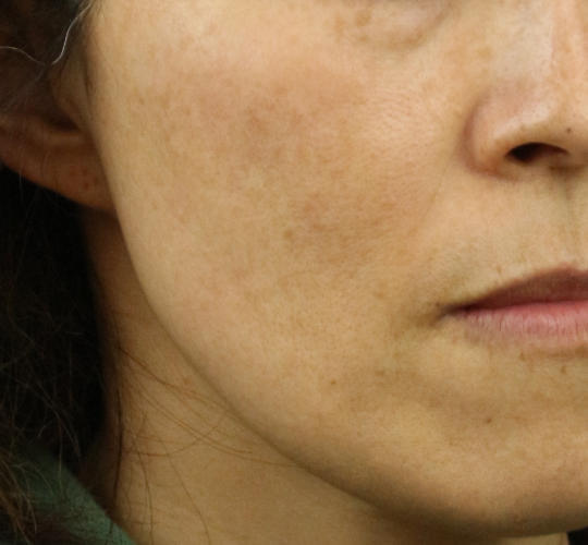 40代女性のリバースピール Before 症例写真