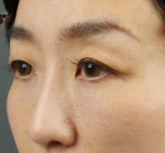 40代女性のアイスレッド After 症例写真