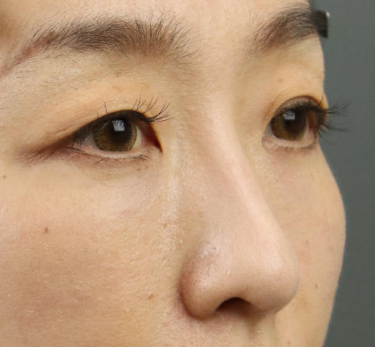 40代女性のアイスレッド After 症例写真