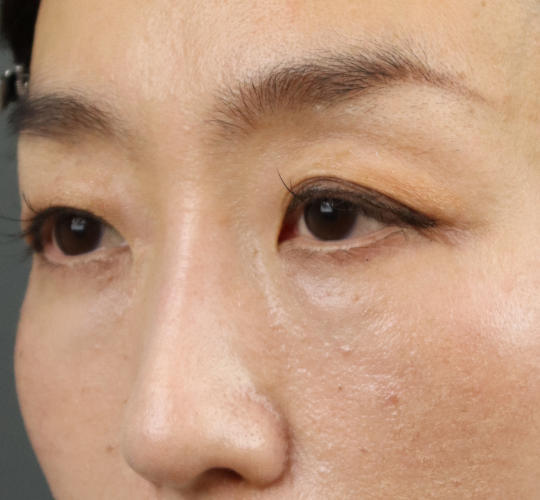 40代女性のアイスレッド Before 症例写真