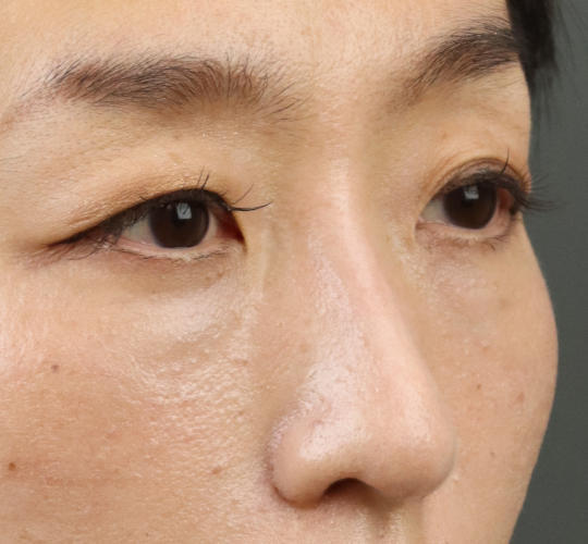 40代女性のアイスレッド Before 症例写真