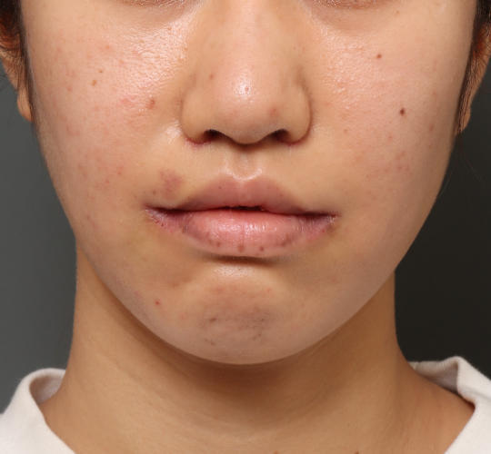 20代女性の鼻の整形 After 症例写真