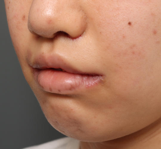 20代女性の人中短縮（リップリフト） After 症例写真
