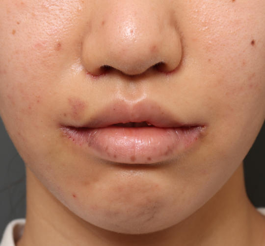20代女性の人中短縮（リップリフト） After 症例写真