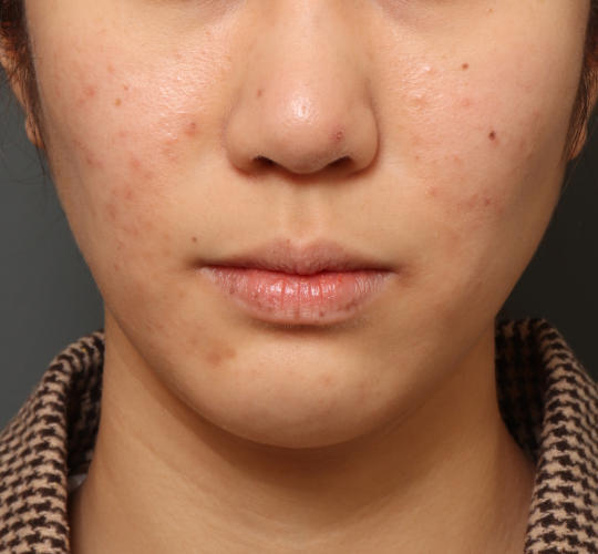 20代女性の鼻の整形 Before 症例写真