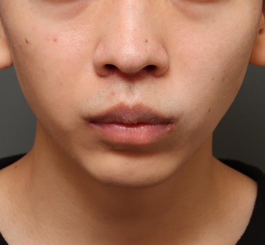 20代男性の鼻の整形 After 症例写真