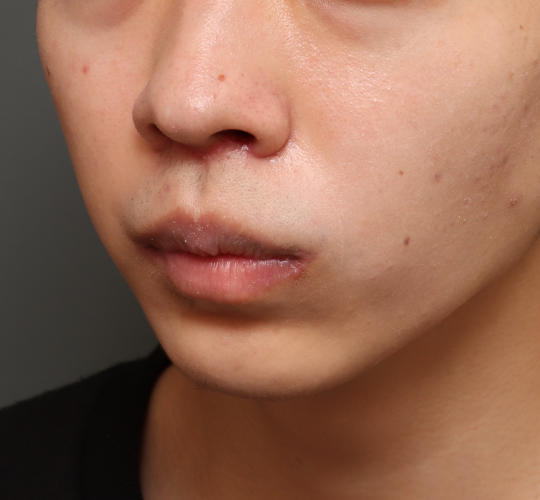 20代男性の人中短縮（リップリフト） After 症例写真