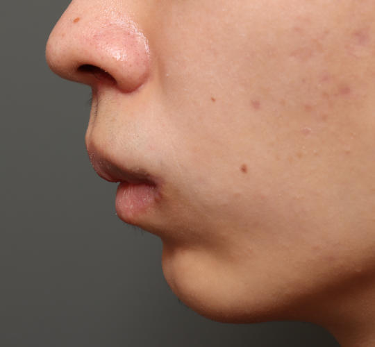 20代男性の人中短縮（リップリフト） After 症例写真