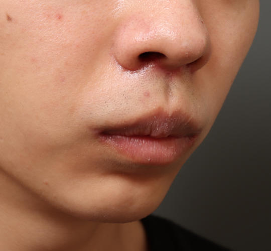 20代男性の人中短縮（リップリフト） After 症例写真