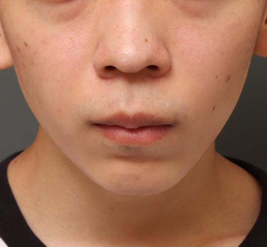 20代男性の鼻の整形 Before 症例写真