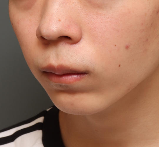 20代男性の人中短縮（リップリフト） Before 症例写真