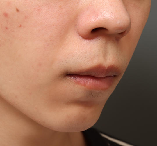 20代男性の人中短縮（リップリフト） Before 症例写真