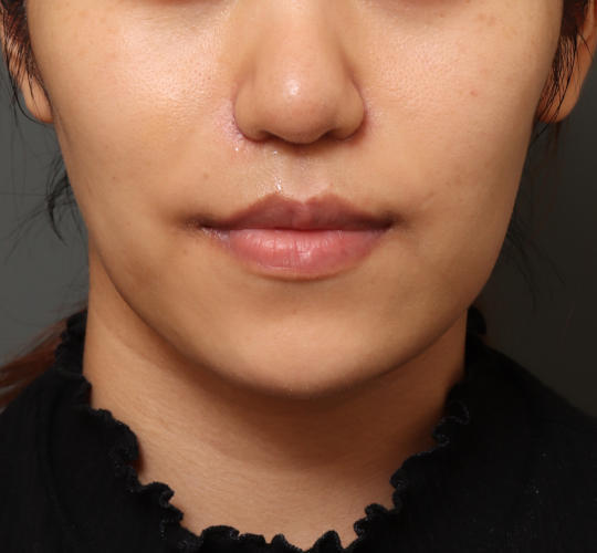 20代女性の人中短縮（リップリフト） After 症例写真