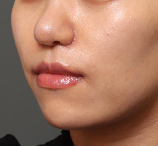20代女性の人中短縮（リップリフト） After 症例写真