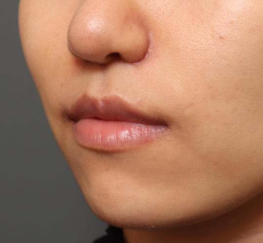 20代女性の鼻の整形 After 症例写真