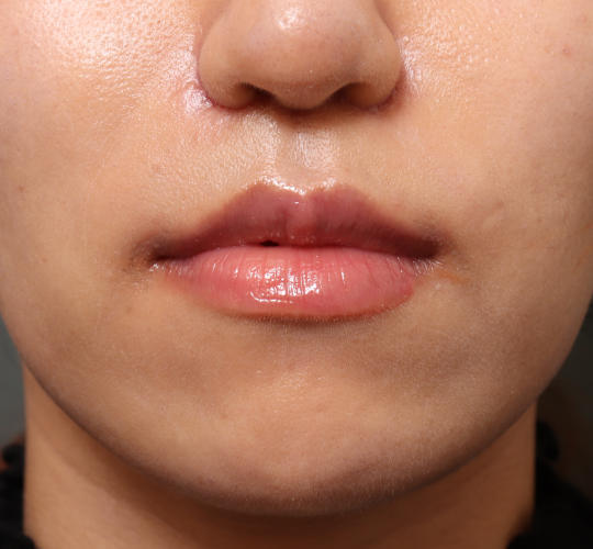 20代女性の人中短縮（リップリフト） After 症例写真