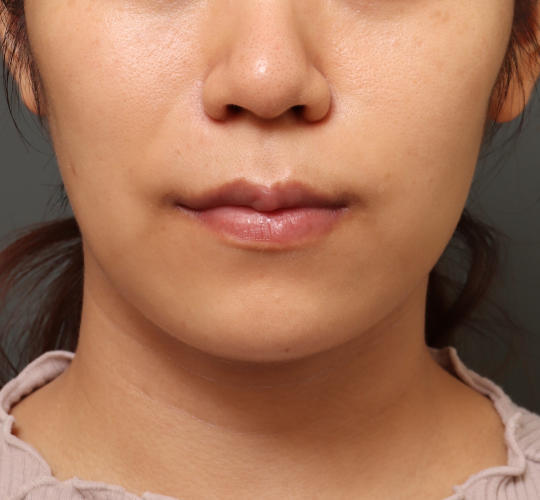 20代女性の人中短縮（リップリフト） Before 症例写真