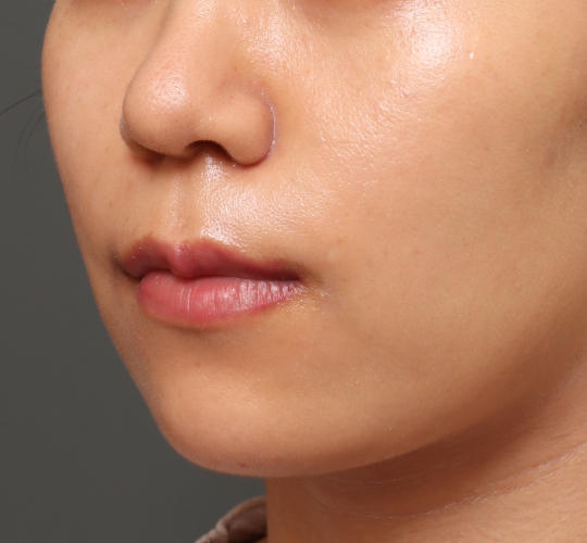 20代女性の人中短縮（リップリフト） Before 症例写真
