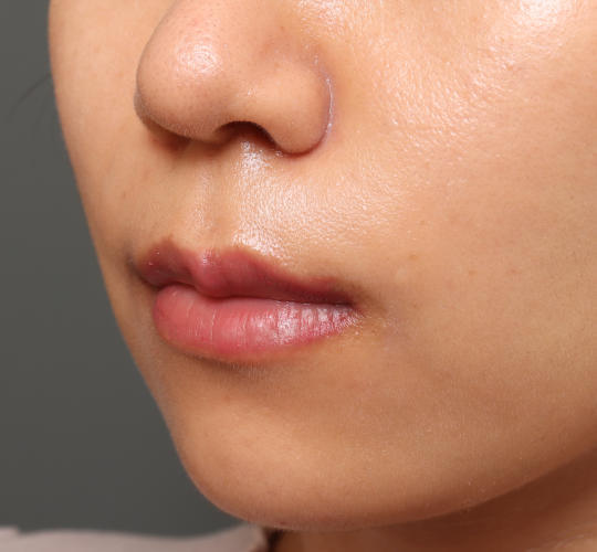 20代女性の鼻の整形 Before 症例写真