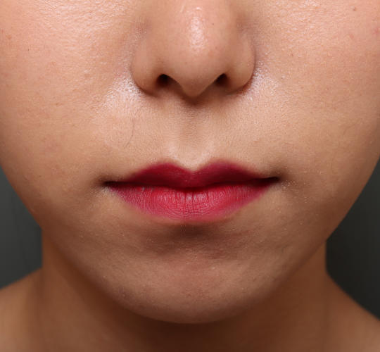 20代女性の鼻の整形 Before 症例写真