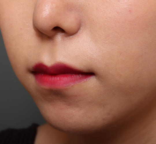 20代女性の人中短縮（リップリフト） Before 症例写真
