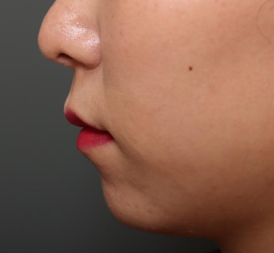 20代女性の人中短縮（リップリフト） Before 症例写真