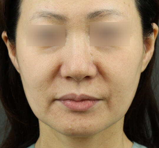 50代女性のグロウHIFUセレクトプラス After 症例写真