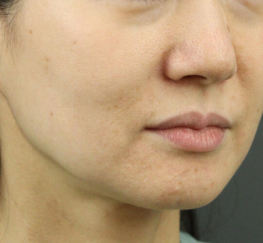 50代女性のグロウHIFUセレクトプラス After 症例写真