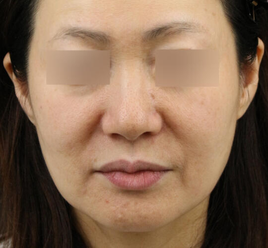 50代女性のグロウHIFUセレクトプラス Before 症例写真