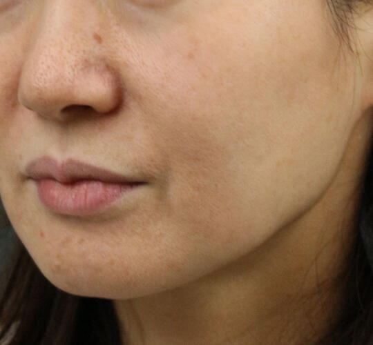 50代女性のシミ・そばかす Before 症例写真