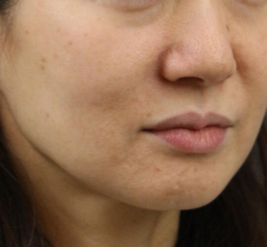 50代女性のグロウHIFUセレクトプラス Before 症例写真