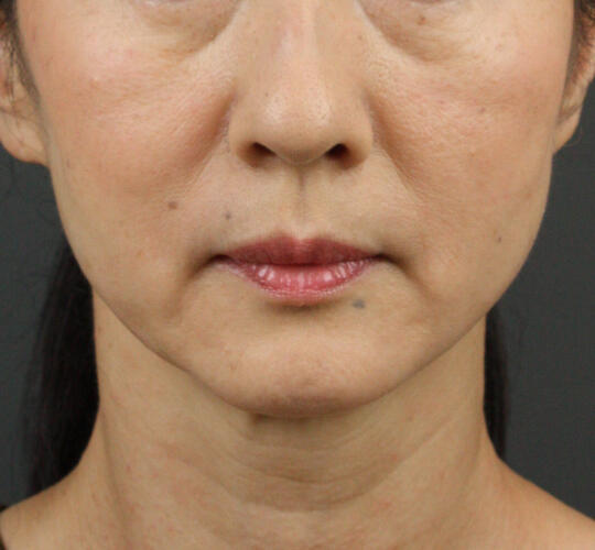 50代女性のVOVリフトプレミアム After 症例写真