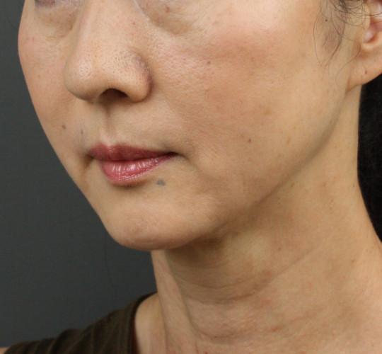 50代女性のVOVリフトプレミアム After 症例写真