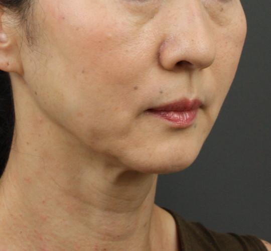 50代女性のVOVリフトプレミアム After 症例写真
