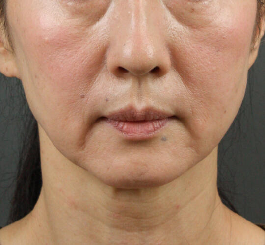 50代女性のVOVリフトプレミアム Before 症例写真